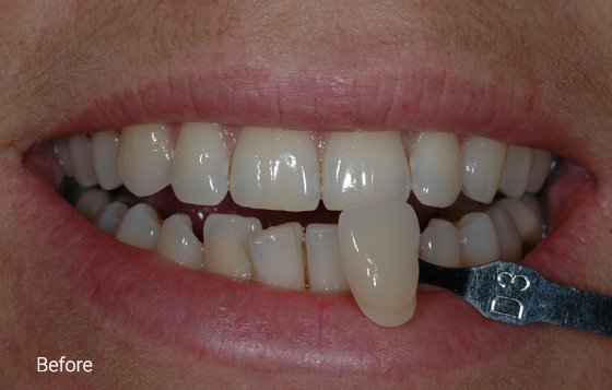 before teeth whitening 1