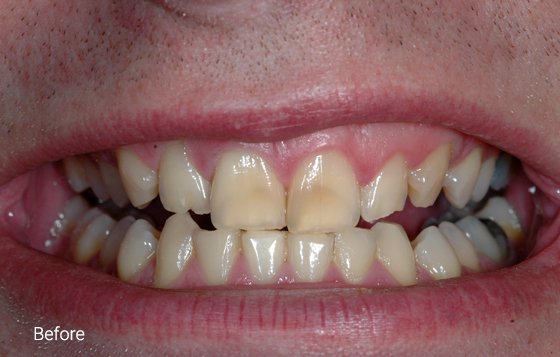 before teeth whitening 2