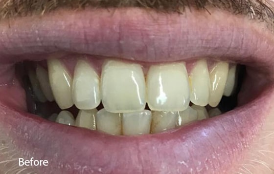 before teeth whitening 10