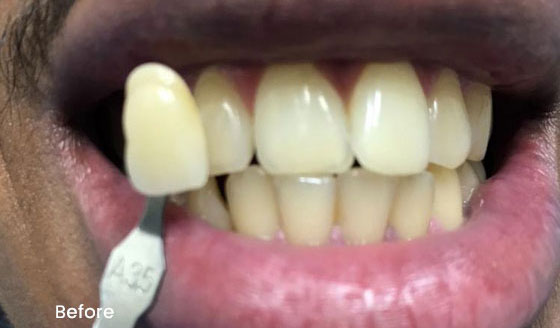 London Teeth Whitening Before 8