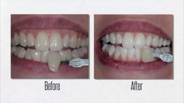 Teeth Whitening procedure by Dr. Sia Mirfendereski