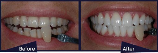 Home teeth whitening before after