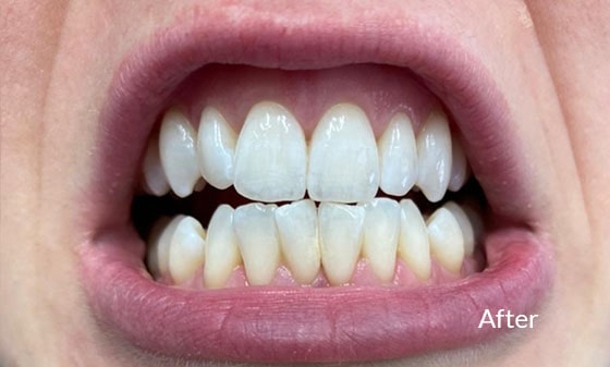 Invisalign and Bonding After 1 - London Teeth Whitening