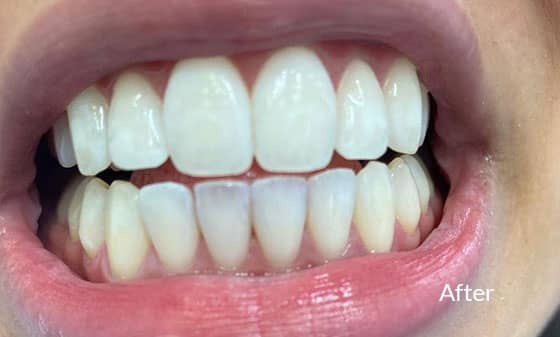 Teeth Whitening After 4 - London Teeth Whitening