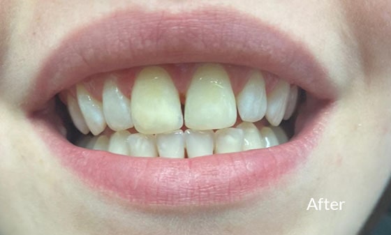 Teeth Whitening After 6 - London Teeth Whitening