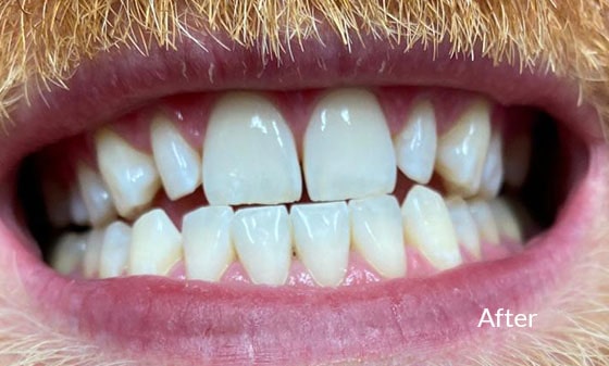 Teeth Whitening After 8 - London Teeth Whitening