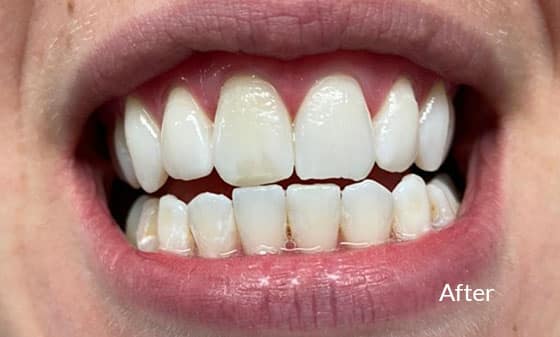 Teeth Whitening After 9 - London Teeth Whitening