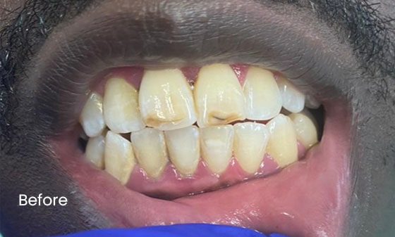 LTW teeth Whitening Before 16