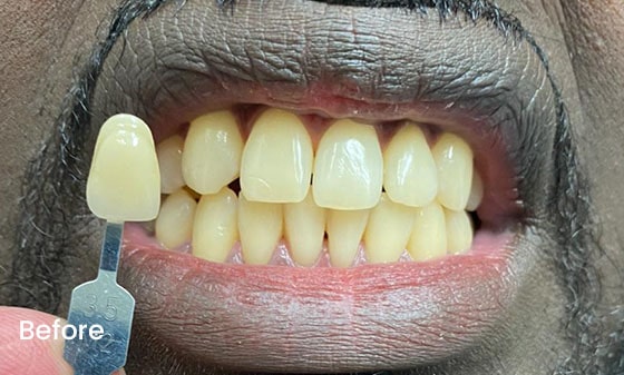 Teeth Whitening Before 17