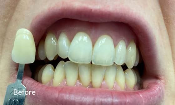Invisalign and Bonding Before 1 - London Teeth Whitening