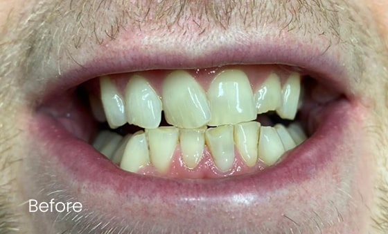 Teeth Whitening Before 31