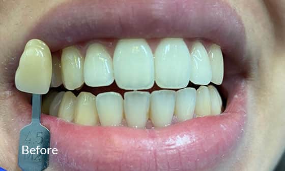 Teeth Whitening Before 4 - London Teeth Whitening