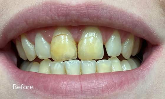 Teeth Whitening Before 6 - London Teeth Whitening