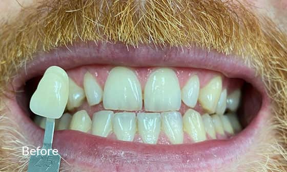Teeth Whitening Before 8 - London Teeth Whitening