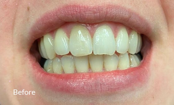 Teeth Whitening Before 9 - London Teeth Whitening