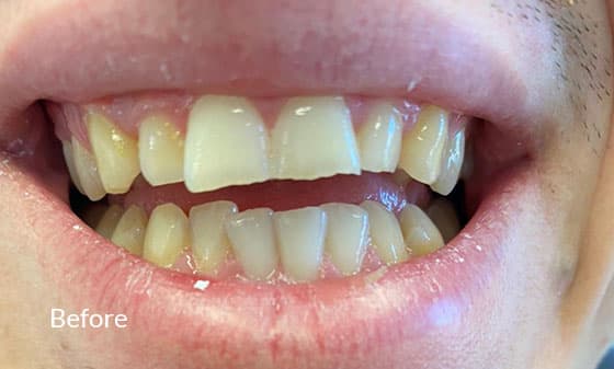 teeth whitening before1
