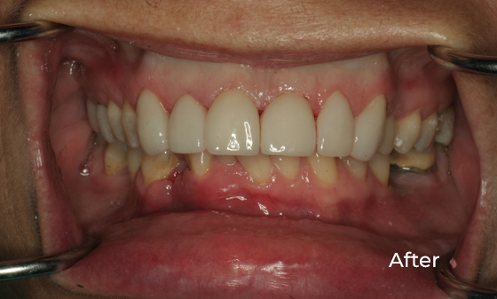 Upper veneers to better shape and alignment of teeth After