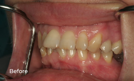 Upper veneers to better shape and alignment of teeth before